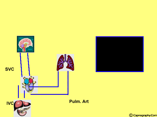 End tidal CO2 and air embolism End tidal CO2 and air embolism