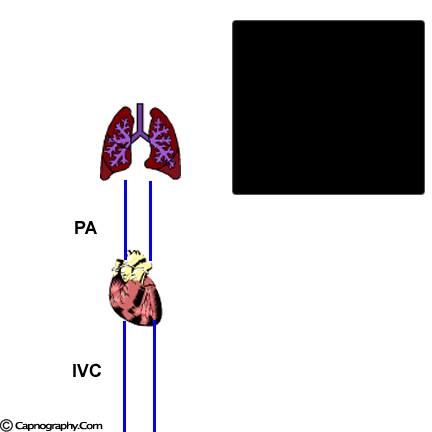 end tidal CO2 and thrombo embolism end tidal CO2 and thrombo embolism