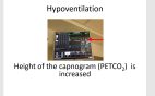 capnography nasal sampling