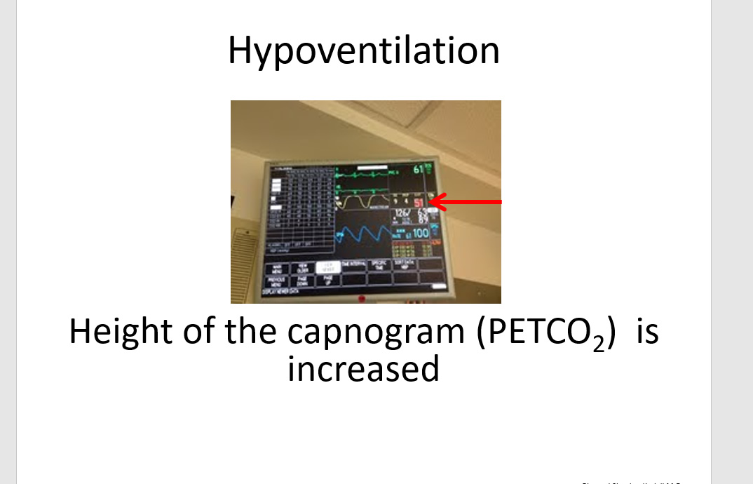 capnography nasal sampling