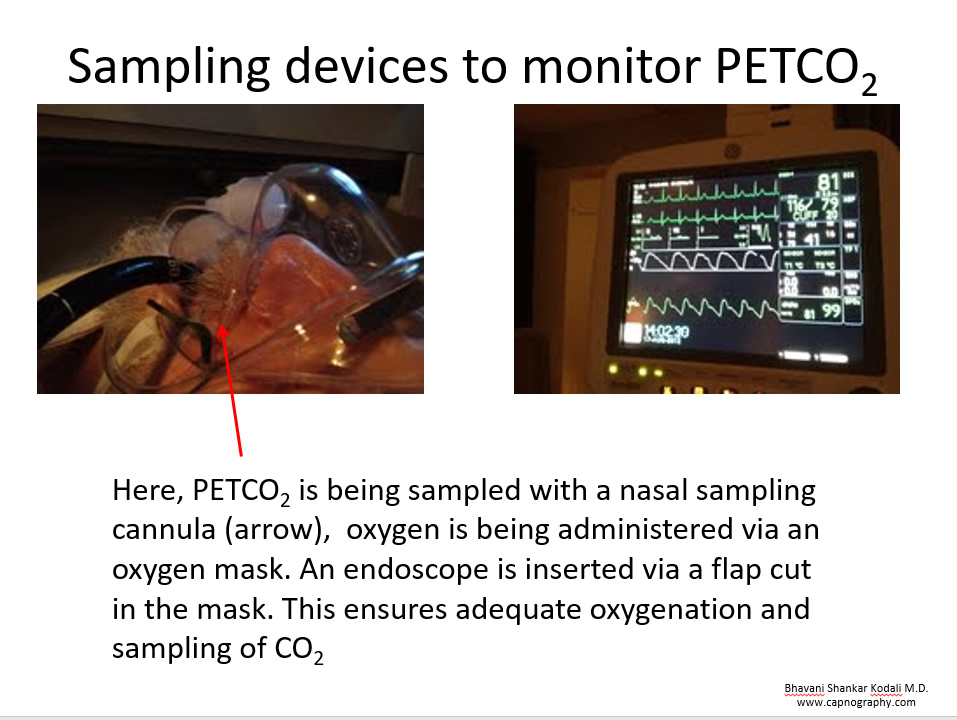 nasal sampling of expired gases with simultaneous oxygen administration